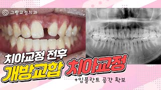 개방교합 치아교정 전후영상_그랑교정치과