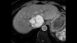 Liver MRI/basics/protocol