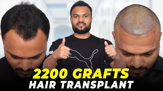 Hair Transplant in Jaipur | Best Results & Cost of Hair Transplant in Jaipur