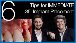 🇺🇸 [Immediate Dental Implant Placement] 6 Tips for Success - Implantology Talks