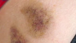 Dark Bruise Makeup Tutorial | Freakmo