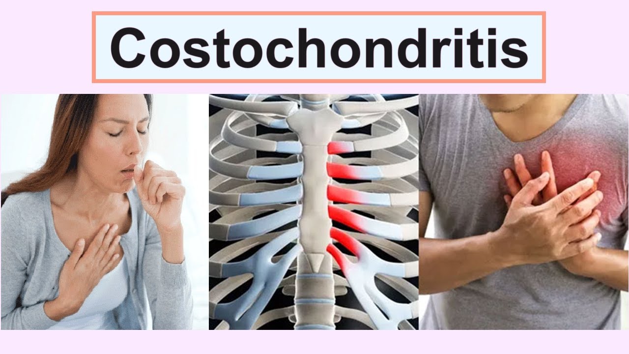 Costochondritis - YouTube