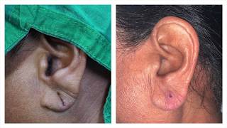 Ear Lobe Repair Surgery for stretched earring holes