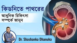 কিডনি পাথর এর আধুনিক চিকিৎসা | Modern treatment of kidney stones | Kidney Stones Treatment | Ep.:526