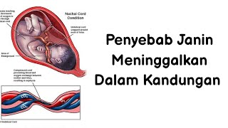 PENYEBAB JANIN MENINGGAL DALAM KANDUNGAN, KEMATIAN JANIN DALAM KANDUNGAN, BIDAN ISNA