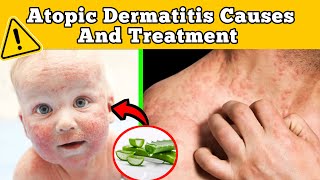 “Atopic Dermatitis Explained: Foods to Avoid, Remedies \u0026 Healing Hacks”