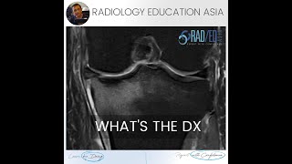 WHAT'S THE Dx: SUBCHONDRAL INSUFFICIENCY FRACTURE