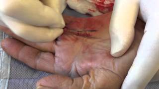 Percutaneous Needle Fasciotomy