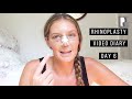 Rhinoplasty Video Diary - Day 6 After Surgery (5 of 15)