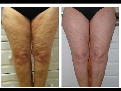 tratamiento para celulitis y flacidez en piernas tratamiento para celulitis y flacidez en piernas