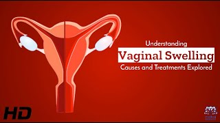 Vaginal Swelling Explained: Insights on Treatment Options