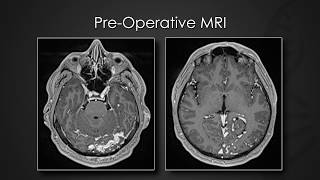 Staged transarterial endovascular embolization of malignant dAVF using Onyx \u0026 n-butyl cyanoacrylate