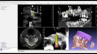 GuideMia implant software demo: design and communication with an immediate tooth extraction acase