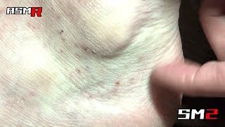 [Eczema ASMR ] The sound of scratching the lower part of an itchy ankle with a nail/sleeping/massage