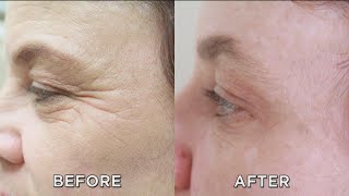 Fix Your Wrinkles in Just Minutes?