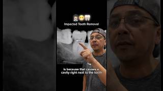 How Removing IMPACTED Wisdom Tooth will PREVENT Futute Dental Problems | View Mobile Dental #shorts