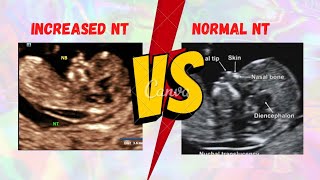 Nuchal translucency (NT)#increased #ntscan #11weeks3 days-13 weeks 6 days#CRL:45-84mm