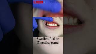 Signs of Over Brushing Teeth#shorts#English#For more videos Do Subscribe