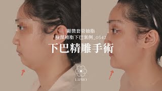 臉部精雕手術｜顯微套管抽脂｜臉部補脂下巴案例_0542