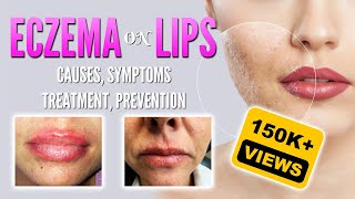 Eczema on lips causes, symptoms, treatment, remedies, prevention | Lip dermatitis, Lip Cheilitis