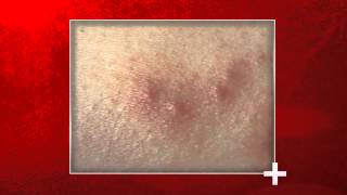 Bed Bug Bites: Signs & Health Impact | National Pest Management Association