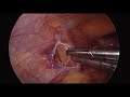 laparoscopic varicocelectomy