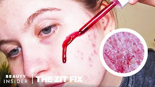 $7 Peel Claims To Unclog Pores And Even Texture | The Zit Fix