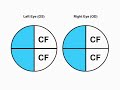 confrontation visual field testing