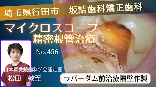 456.館林市伊奈町マイクロスコープ根管治療坂詰歯科・矯正歯科隔壁作製