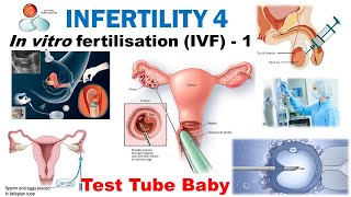 In Vitro Fertilisation (IVF) | Assisted Reproductive Technology | Inter Cytoplasmic Sperm Injection