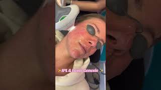 The Secret Benefits of IPL and Laser Genesis