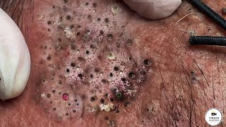 Squeezing blackheads and pimples from an elderly woman's face - Very Satisfactory Video.