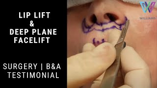 Lip Lift & Deep Plane Facelift Surgery & Patient Results/Testimonial