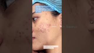 หลังรักษาหลุมสิวแบบจิกลึก Ice Pick Acne Scar ด้วยการแต้มกรด TCA CROSS จะมีลักษณะอย่างไร? หมอรุจ