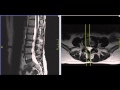 Far Lateral Lumbar Disc Herniation MRI Explained | Dr. Jeffrey P. Johnson | HD