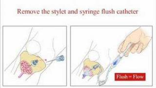 EZ-IO Intraosseous cannulation