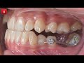 Class III tx with aligners featuring pre-aligner therapy｜【Chris Chang Ortho】CC649