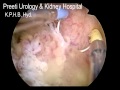 BLADDER TUMOR REMOVAL with Bipolar- Preeti Urology and Kidney Hospital