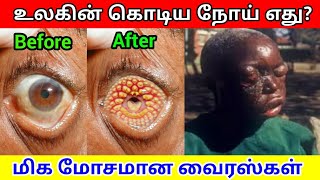 Today News : உலகின் மிக கொடிய நோய் எது? | Most dangerous Diseases in the world | MS