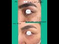 reduction of under eye milia