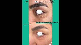 Reduction of under eye milia