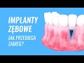 Implanty zębowe | Smile.expert