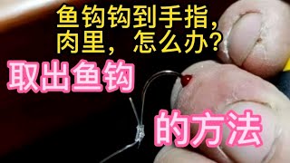 #绑鱼钩钩到手指，肉里，怎么办？#取出鱼钩的方法#钓鱼#热门