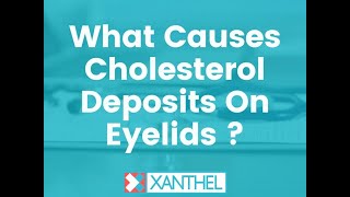 What Causes Cholesterol Deposits On Eyelids ?  By Xanthel ®,