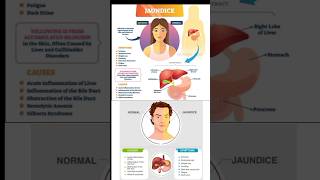 Major Warning Signs Of Jaundice - Mnemonic #medical #health