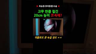 축농증 농빼기 부비동염 수술ㅣ오래 방치된 길고 질긴 콧물