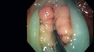 How to do and not to do an Endoscopic Mucosal Resection (EMR)