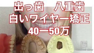 ９２）1年で八重歯　抜歯しない白いワイヤー矯正　費用安い　出っ歯　大宮駅西口鈴木歯科医院　高校生　中学生