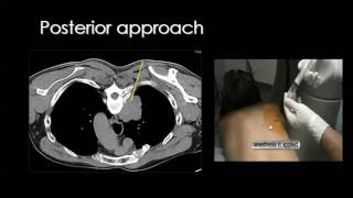 Thoracic interventional radiology Dr Mamdouh Mahfouz 720p