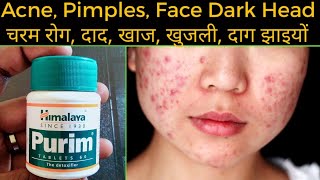 Purim Tablets Himalaya Use or Benefits in Hindi | कील, मुँहासे, दाग जड़ से खत्म करे